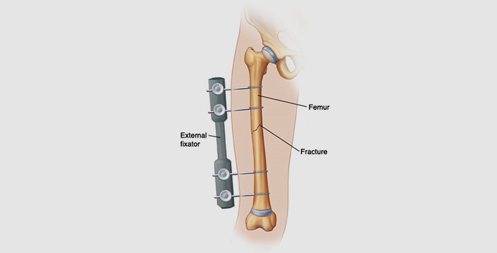 Femur Shaft Fractures, Causes, Symptoms & Treatment