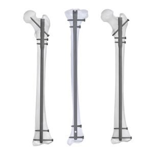 Tibia & Femur Nailing System
