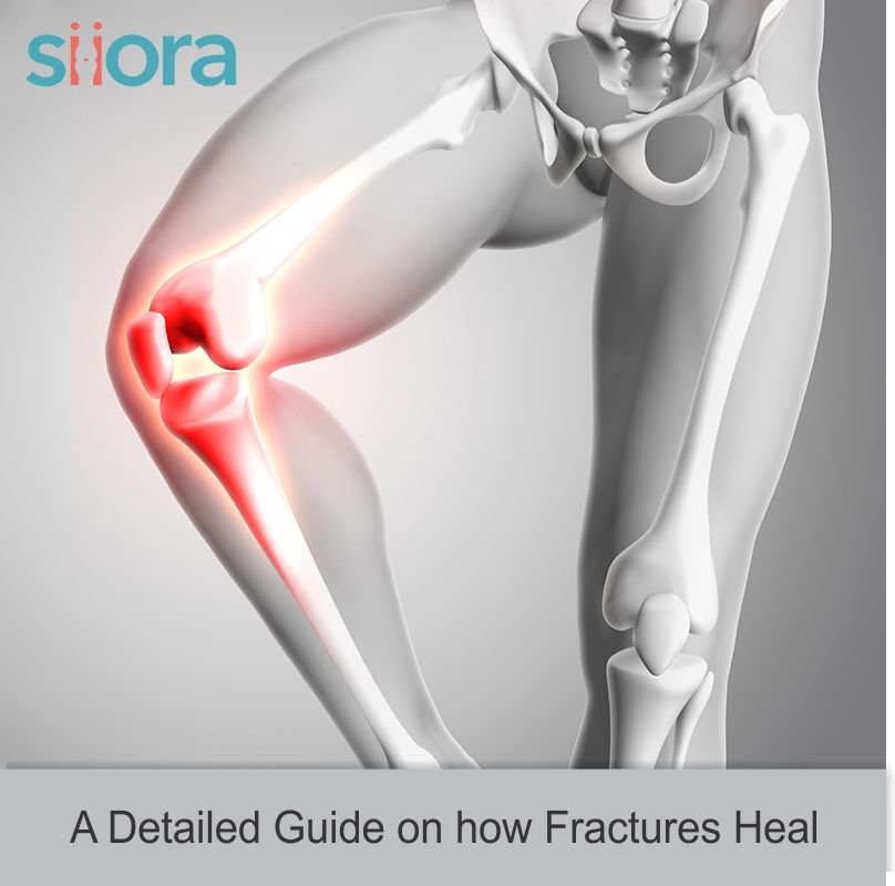 Read more about the article A Detailed Guide on How Fractures Heal