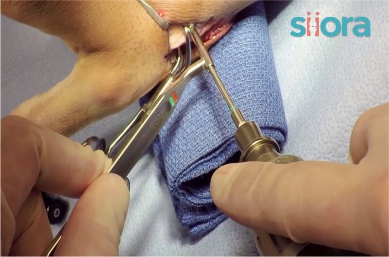 ORIF Surgery