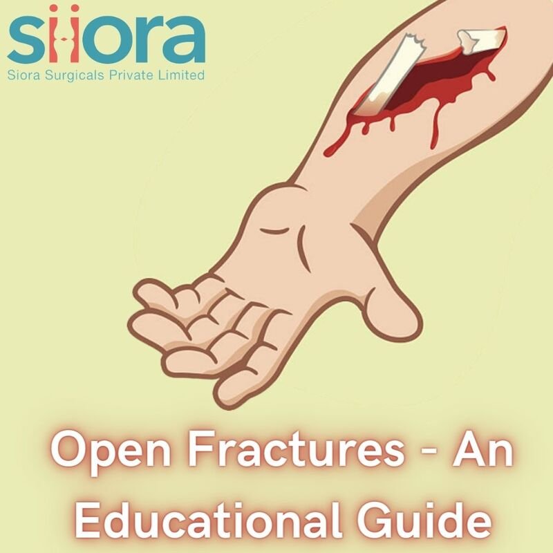 Read more about the article Open Fractures – An Educational Guide