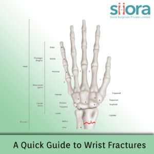 A Quick Guide to Wrist Fractures