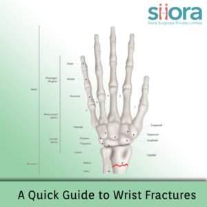 A Quick Guide to Wrist Fractures