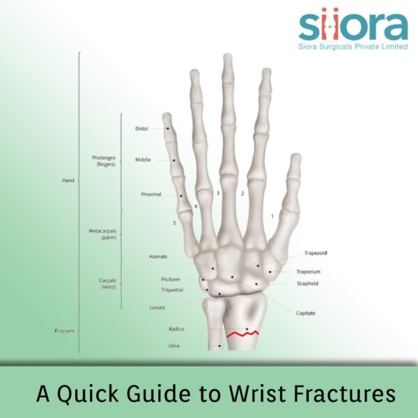Wrist Fractures A Quick Guide Siora Surgicals Pvt. Ltd.