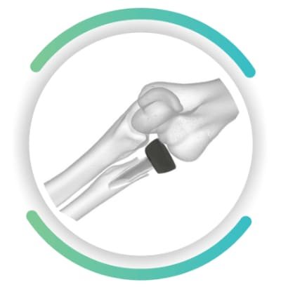 Radial Head Prosthesis