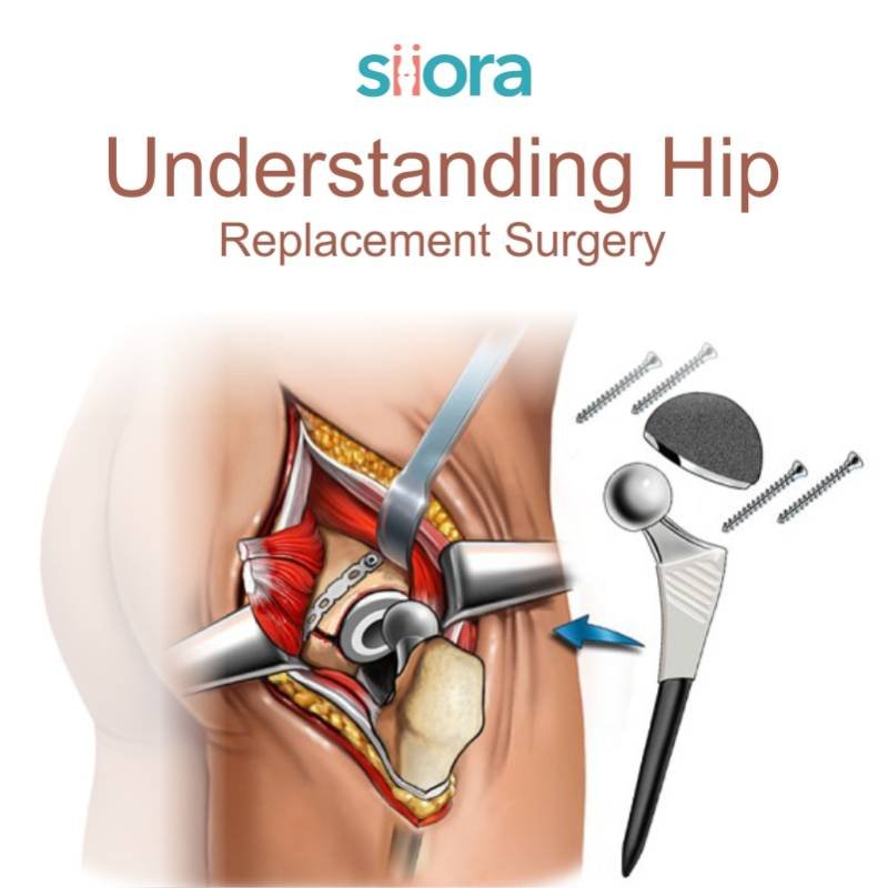 Read more about the article Understanding Hip Replacement Surgery