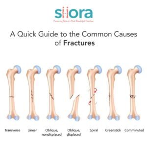 A Quick Guide to the Common Causes of Fractures