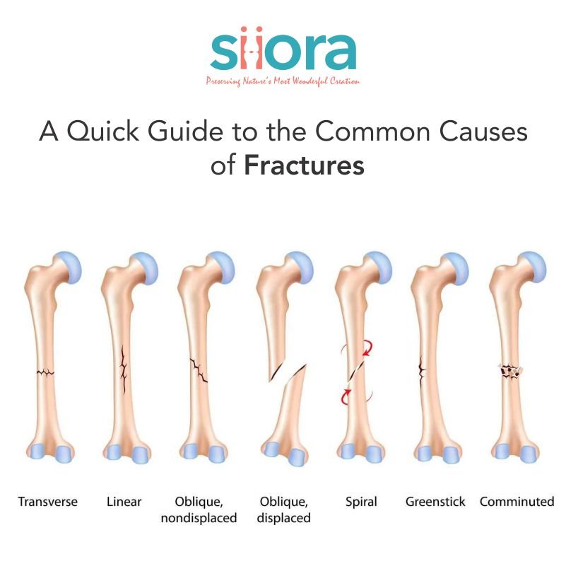 A Quick Guide to the Common Causes of Fractures