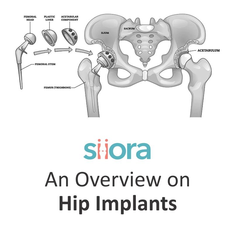 An Overview on Hip Implants