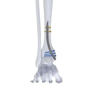 Distlon Distal Tibia Nail