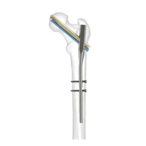 Durofix Intertan Nailing System