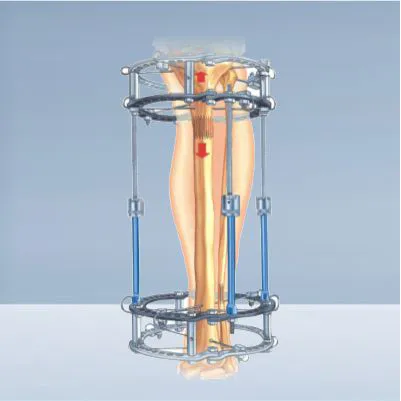 External Fixator System front image