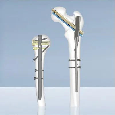 Intramedullary Nailing System front