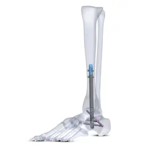 Tarsofix Ankle Nailing System